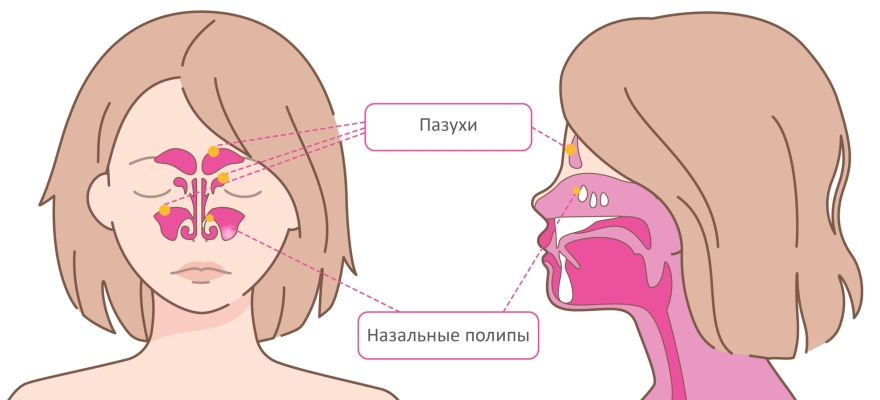 Полипы в носу