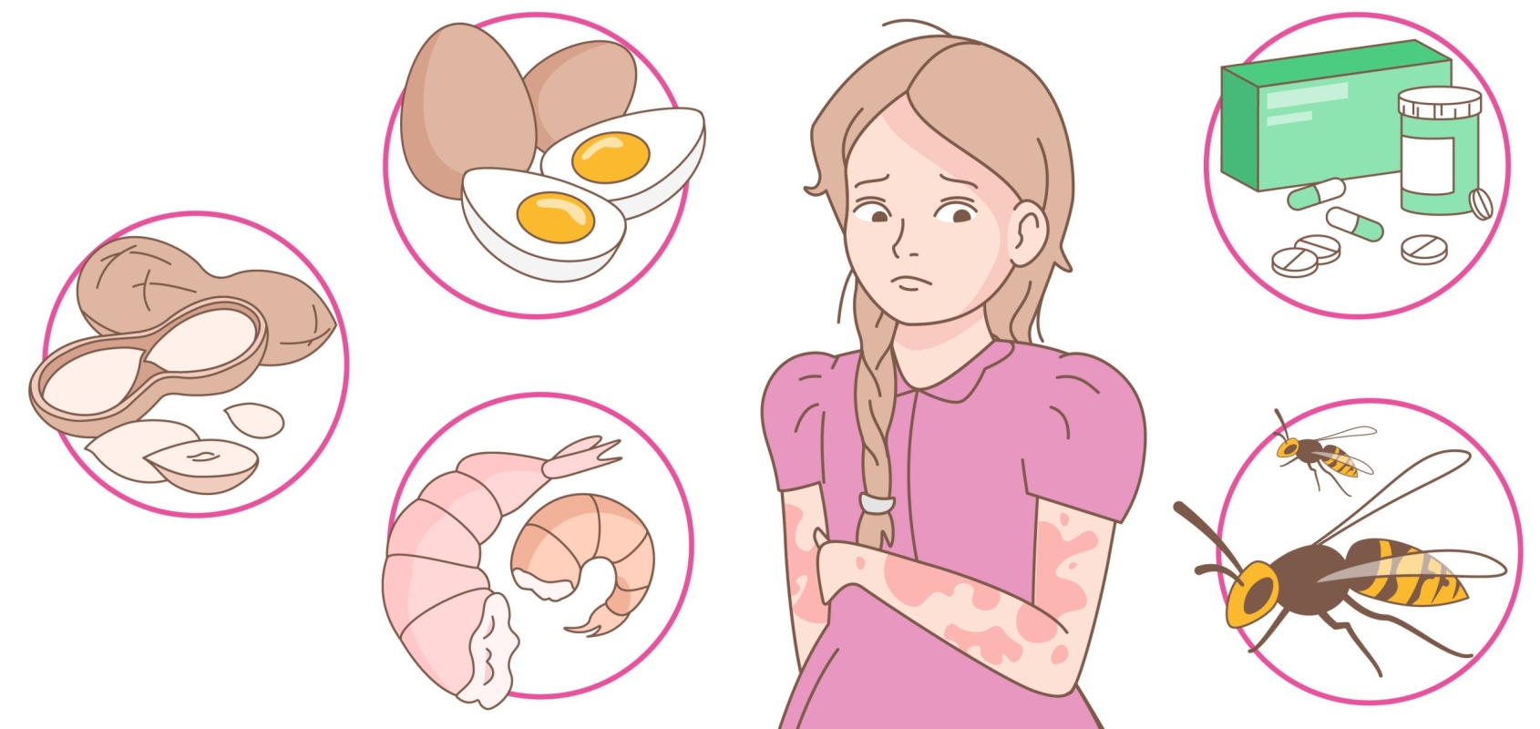 Крапивница у детей: современное лечение, препараты