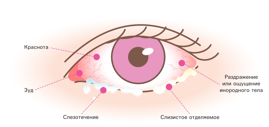 Аллергический конъюнктивит