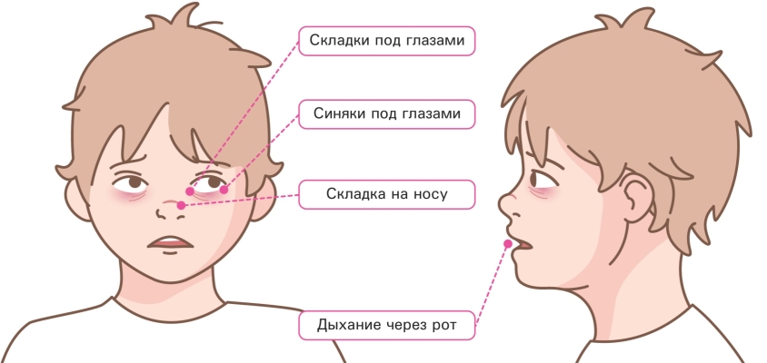 Проявления хронического аллергического ринита