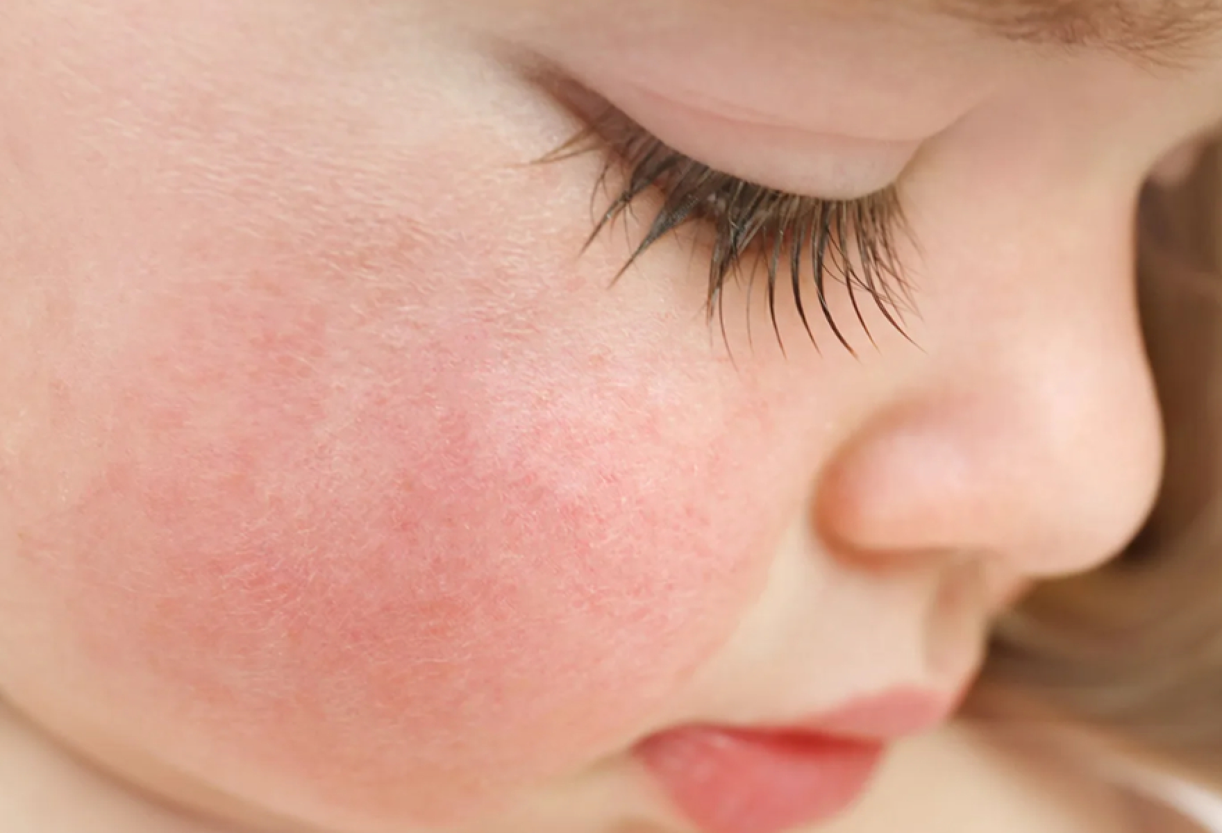 Ребенку год красные щеки. Сыпь на щечках у ребенка пищевая аллергия.