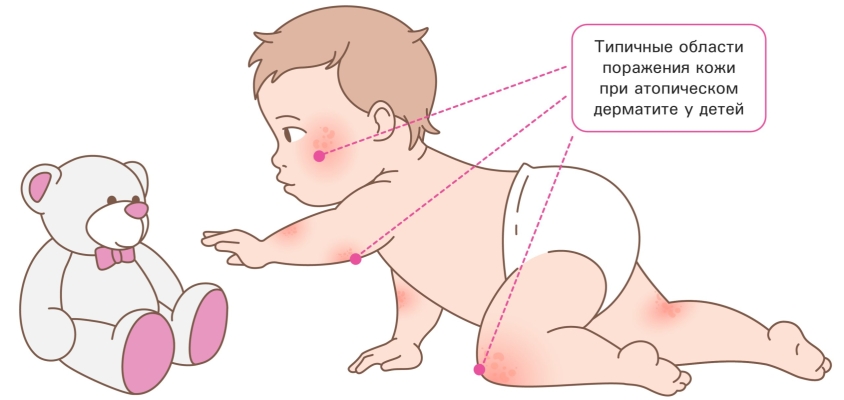 Локализация атопического дерматита у детей