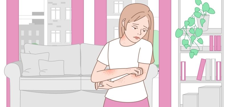 Крапивница