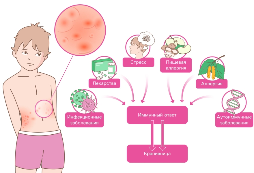 Причины крапивницы