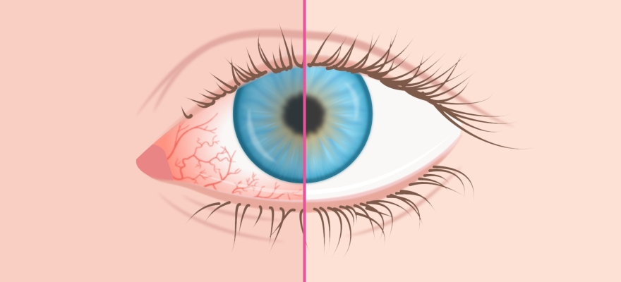 Аллергия как причина зуда глаз