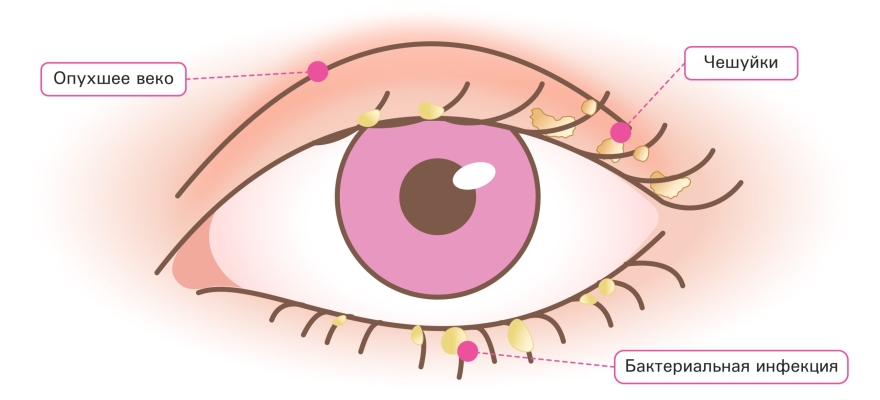 Зуд глаз из-за блефарита